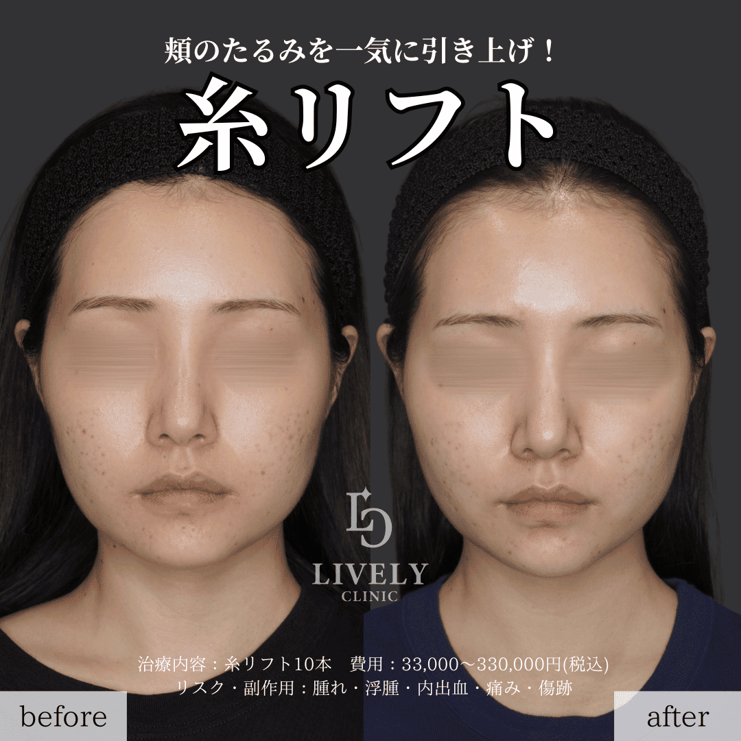 糸リフト
